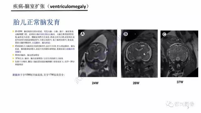 【PPT】MRI of the fetal brain