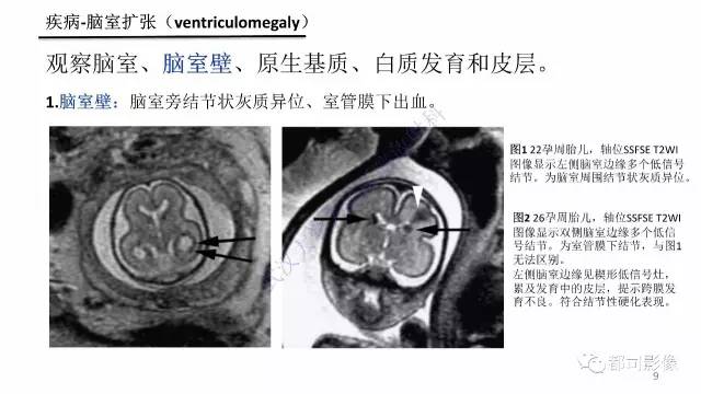【PPT】MRI of the fetal brain