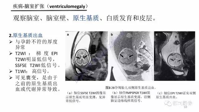 【PPT】MRI of the fetal brain