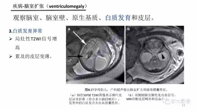 【PPT】MRI of the fetal brain