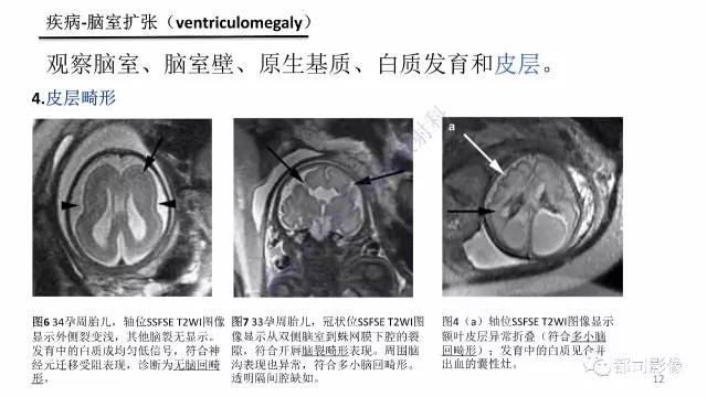 【PPT】MRI of the fetal brain