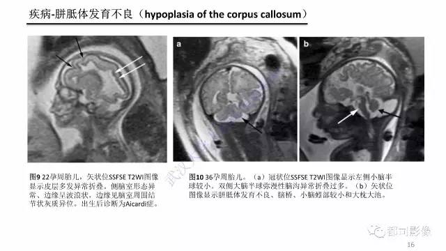 【PPT】MRI of the fetal brain