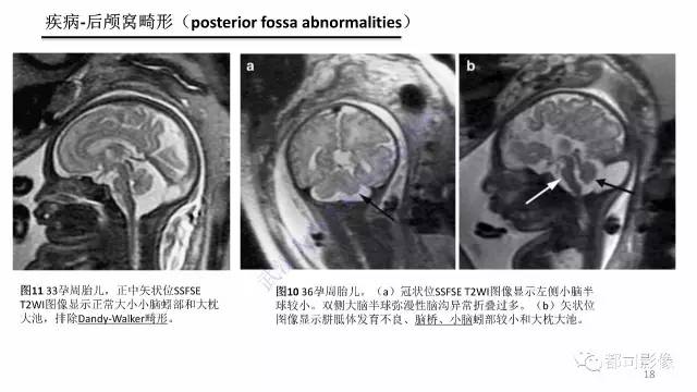 【PPT】MRI of the fetal brain