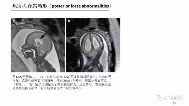 【PPT】MRI of the fetal brain