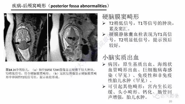 【PPT】MRI of the fetal brain