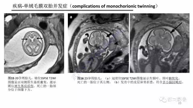 【PPT】MRI of the fetal brain