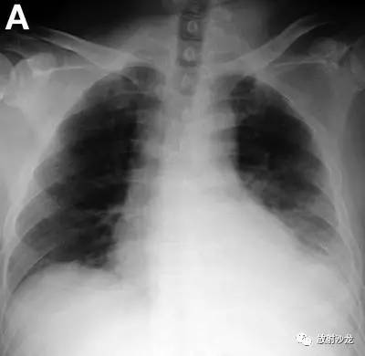 【病例】自发性食管破裂1例X线CT影像表现 【病例】自发性食管破裂1例X线CT影像表现