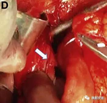 【病例】自发性食管破裂1例X线CT影像表现 【病例】自发性食管破裂1例X线CT影像表现