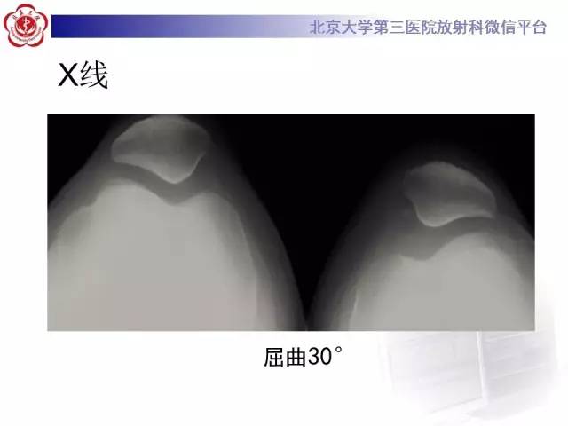 【病例】髌股关节不稳1例X线CT及MR影像表现