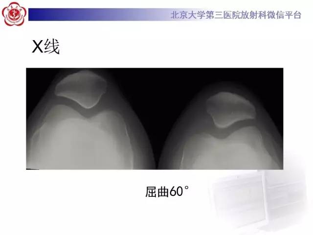【病例】髌股关节不稳1例X线CT及MR影像表现
