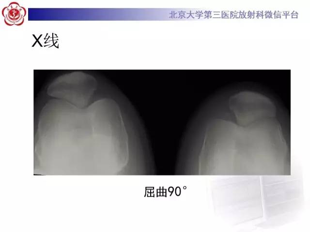 【病例】髌股关节不稳1例X线CT及MR影像表现
