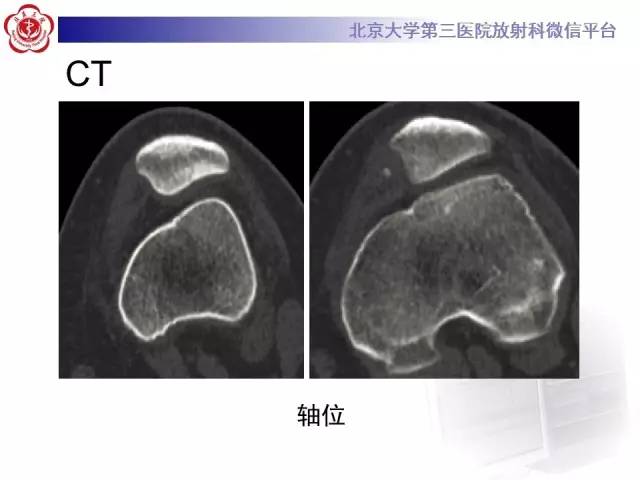 【病例】髌股关节不稳1例X线CT及MR影像表现
