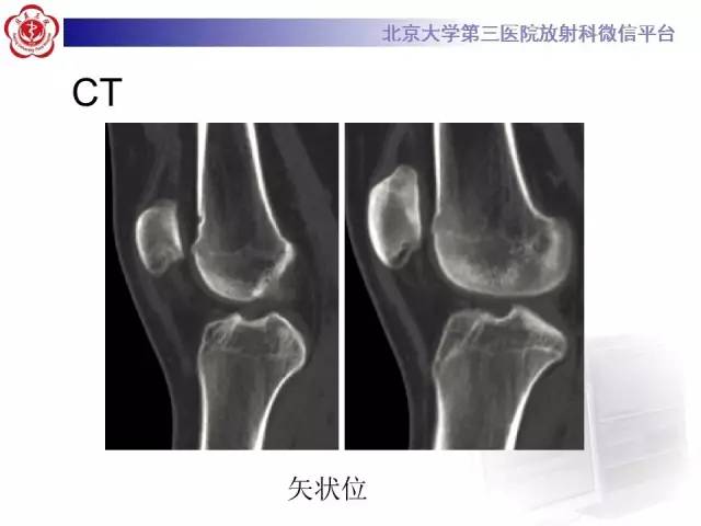 【病例】髌股关节不稳1例X线CT及MR影像表现