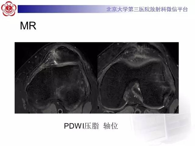 【病例】髌股关节不稳1例X线CT及MR影像表现