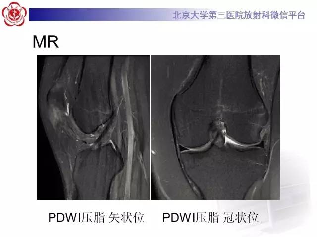 【病例】髌股关节不稳1例X线CT及MR影像表现