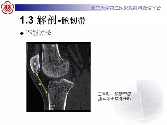 【病例】髌股关节不稳1例X线CT及MR影像表现