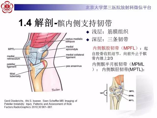 【病例】髌股关节不稳1例X线CT及MR影像表现