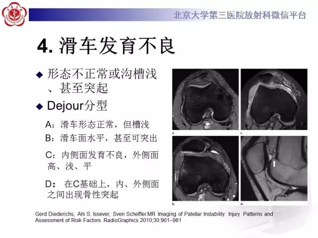 【病例】髌股关节不稳1例X线CT及MR影像表现