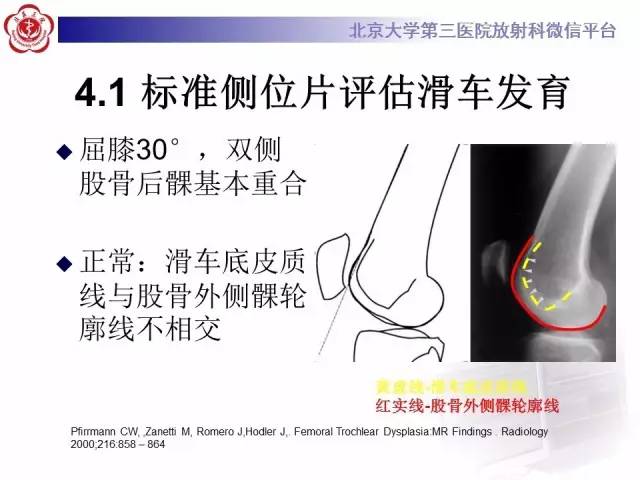 【病例】髌股关节不稳1例X线CT及MR影像表现