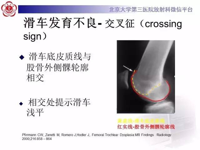 【病例】髌股关节不稳1例X线CT及MR影像表现