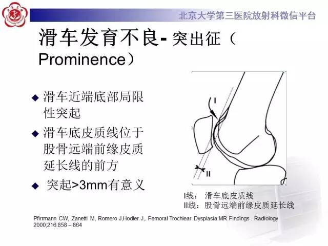 【病例】髌股关节不稳1例X线CT及MR影像表现