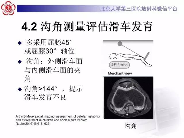 【病例】髌股关节不稳1例X线CT及MR影像表现