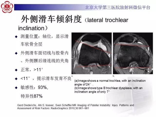 【病例】髌股关节不稳1例X线CT及MR影像表现