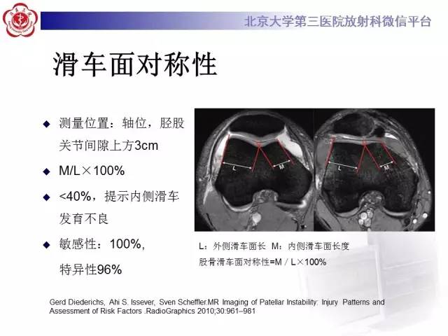 【病例】髌股关节不稳1例X线CT及MR影像表现