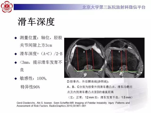 【病例】髌股关节不稳1例X线CT及MR影像表现
