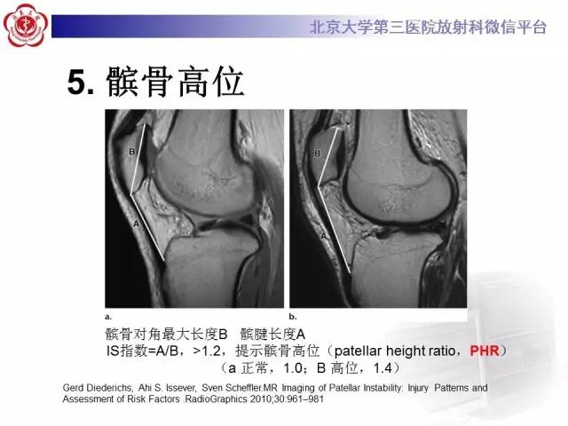 【病例】髌股关节不稳1例X线CT及MR影像表现