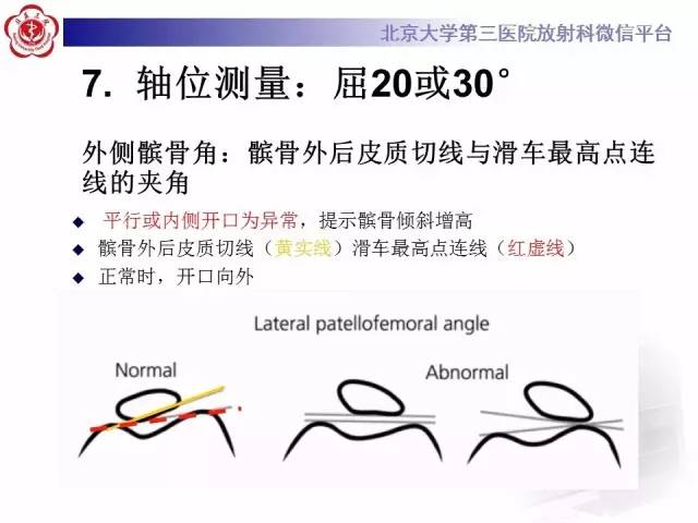 【病例】髌股关节不稳1例X线CT及MR影像表现