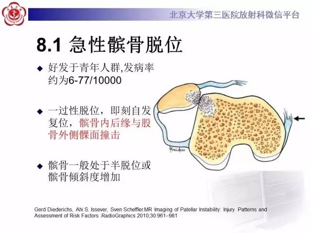 【病例】髌股关节不稳1例X线CT及MR影像表现
