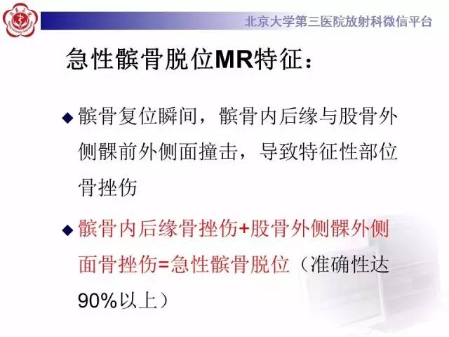 【病例】髌股关节不稳1例X线CT及MR影像表现