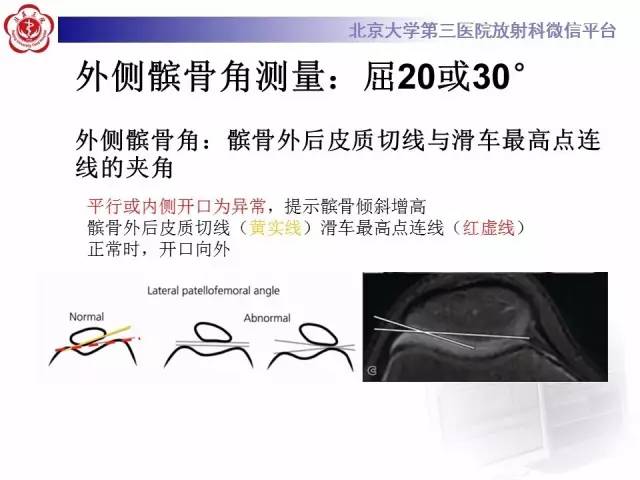 【病例】髌股关节不稳1例X线CT及MR影像表现