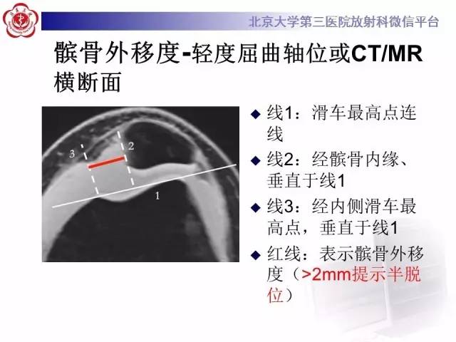 【病例】髌股关节不稳1例X线CT及MR影像表现