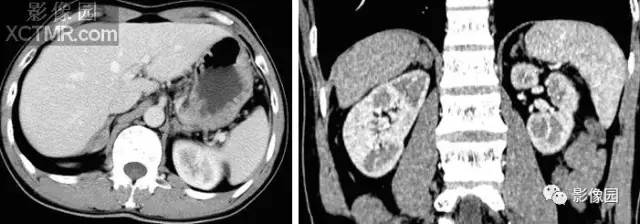 【病例】肾上腺转移癌1例CT 【病例】肾上腺转移癌1例CT