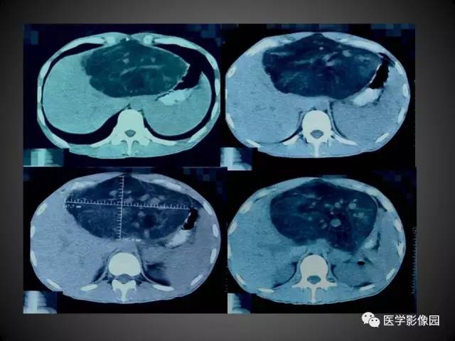 【病例】肝脏巨大血管平滑肌脂肪瘤1例CT