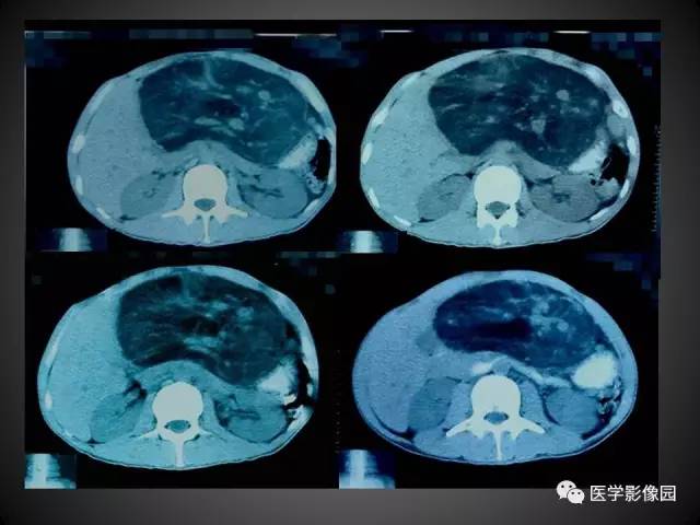 【病例】肝脏巨大血管平滑肌脂肪瘤1例CT