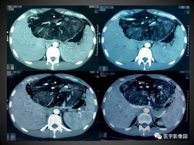 【病例】肝脏巨大血管平滑肌脂肪瘤1例CT