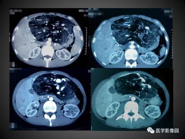 【病例】肝脏巨大血管平滑肌脂肪瘤1例CT