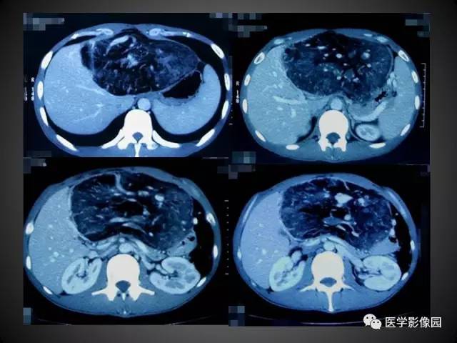 【病例】肝脏巨大血管平滑肌脂肪瘤1例CT