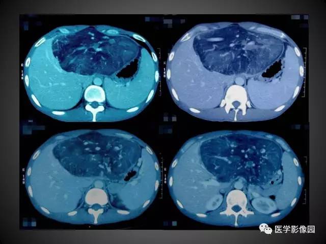 【病例】肝脏巨大血管平滑肌脂肪瘤1例CT