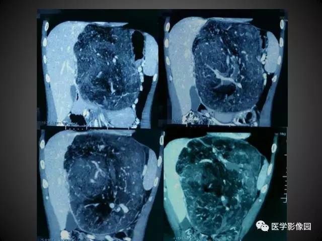 【病例】肝脏巨大血管平滑肌脂肪瘤1例CT