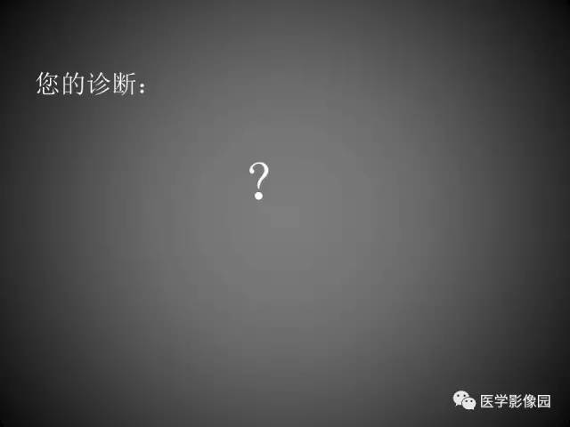 【病例】肝脏巨大血管平滑肌脂肪瘤1例CT