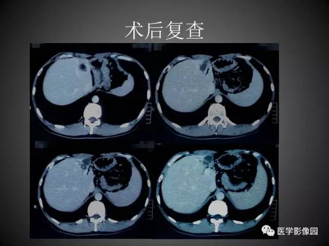 【病例】肝脏巨大血管平滑肌脂肪瘤1例CT