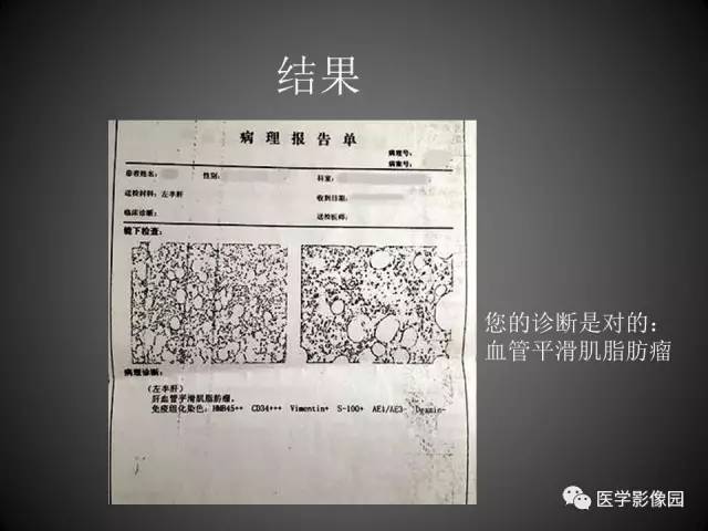 【病例】肝脏巨大血管平滑肌脂肪瘤1例CT