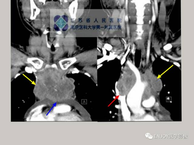 手把手教你会读片——胸腺瘤 手把手教你会读片——胸腺瘤