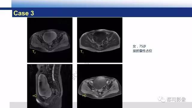 【PPT】卵巢Brenner瘤影像诊断