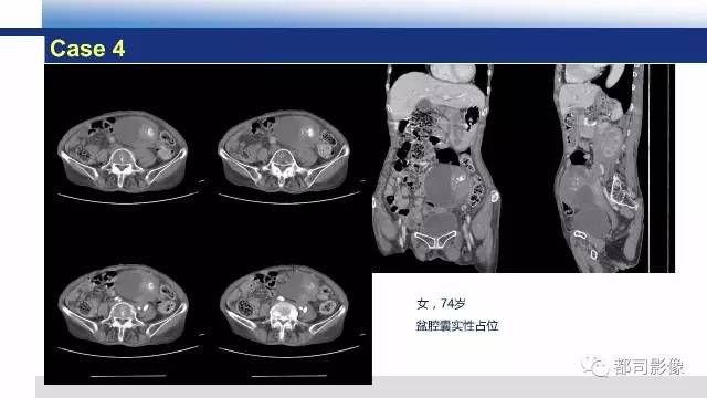 【PPT】卵巢Brenner瘤影像诊断