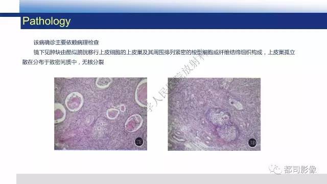 【PPT】卵巢Brenner瘤影像诊断